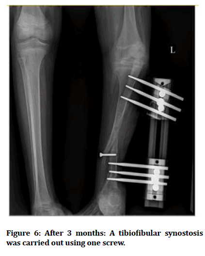 medical-dental-tibiofibular