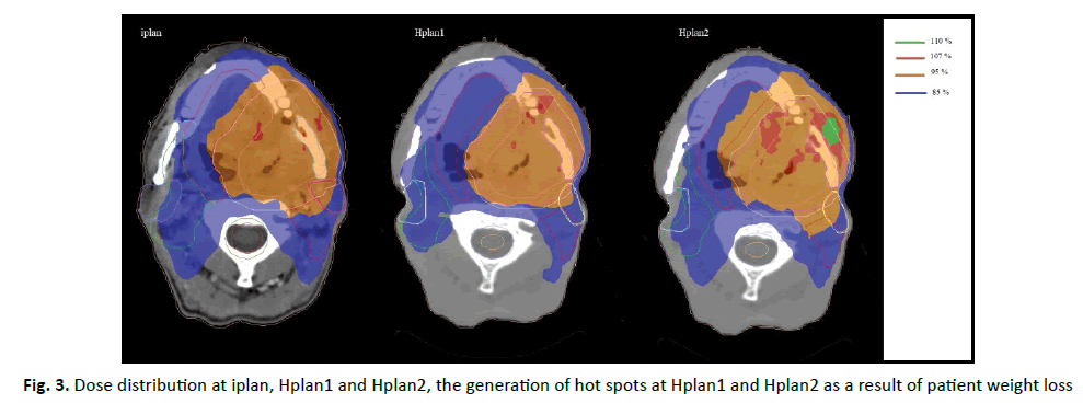 oncologyradiotherapy-Hplan2