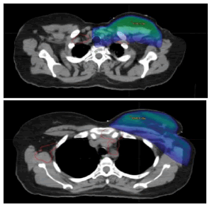 oncologyradiotherapy-lymph