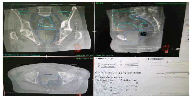 oncologyradiotherapy-prostate