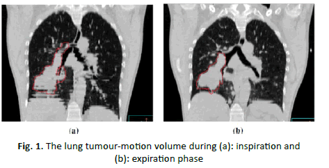 oncologyradiotherapy-tumour-motion