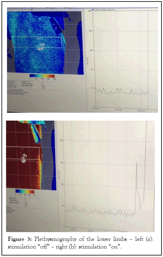 Plethysmography