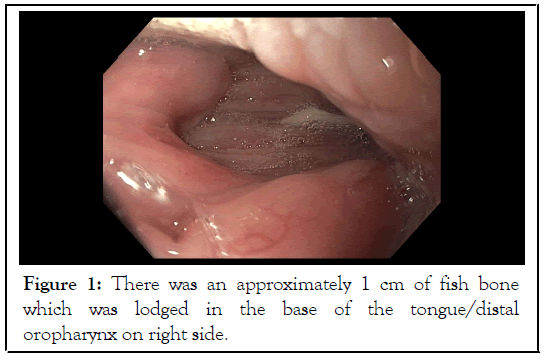 oropharynx