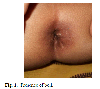 pediatric-urology-boil