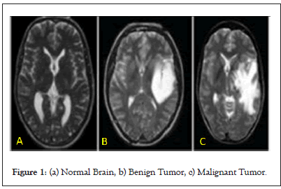 tumor-brain