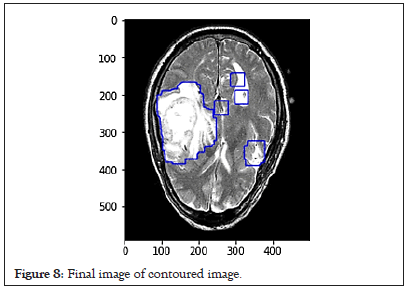 tumor-contoured