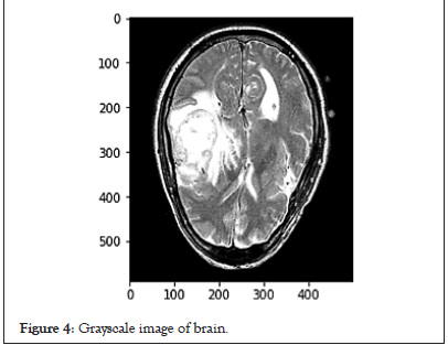 tumor-grayscale