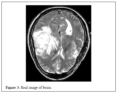 tumor-image