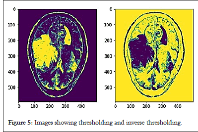 tumor-thresholding