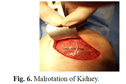 urology-malrotation