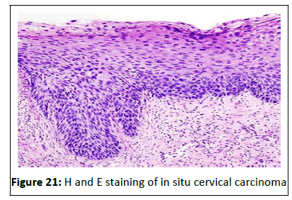 Cancer-Research-carcinoma