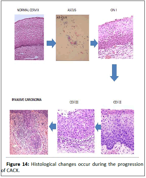 Cancer-Research-progression