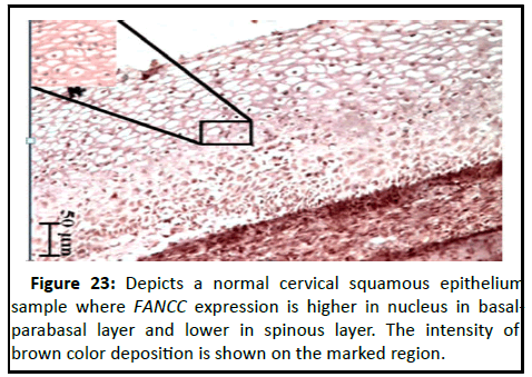 Cancer-Research-squamous