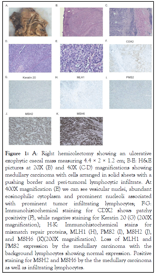 hemicolectomy