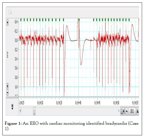 bradycardia