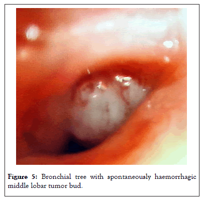 Bronchial