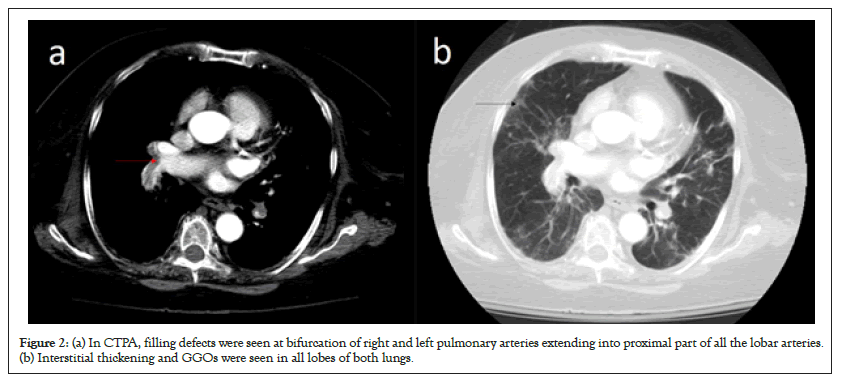 pulmonary