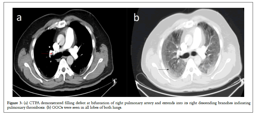 thrombosis