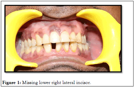 Essences-Dentistry-Missing