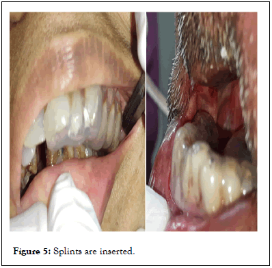Essences-Dentistry-Splints