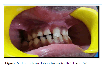 Essences-Dentistry-deciduous