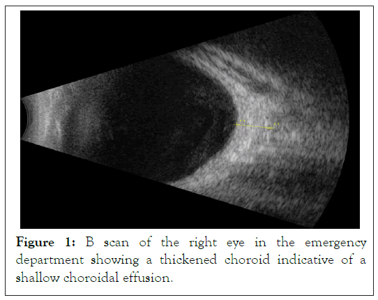 choroid