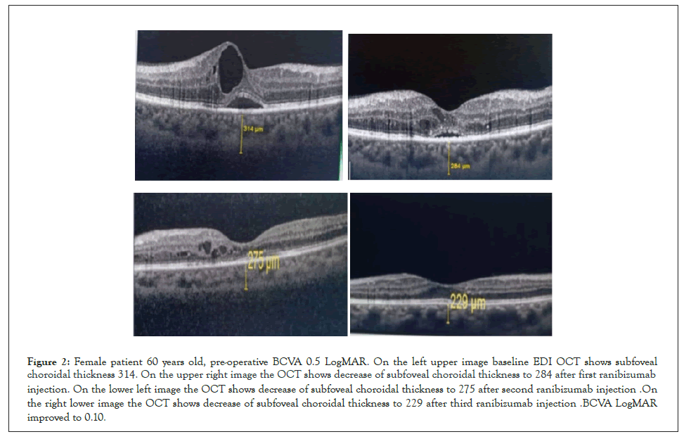 choroidal