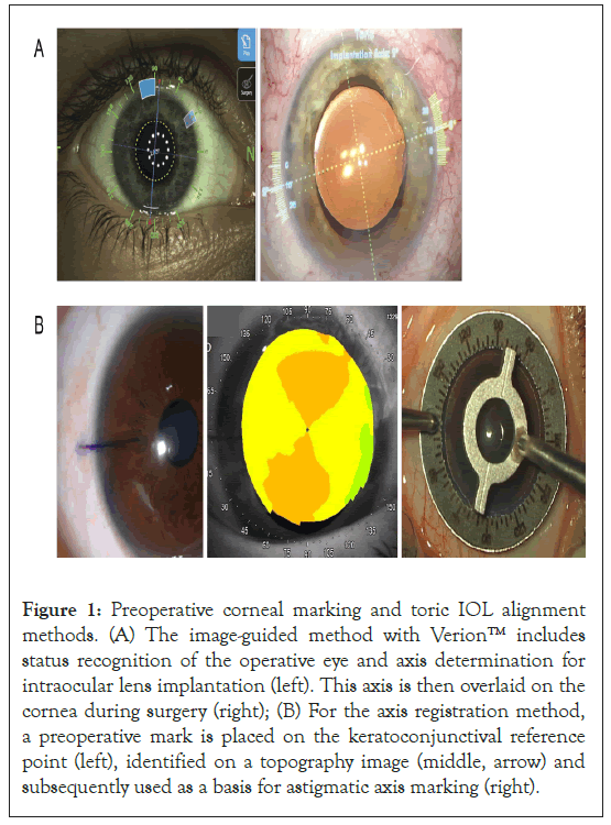 corneal