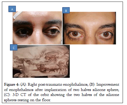 enophthalmos