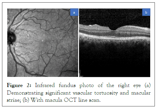 fundus