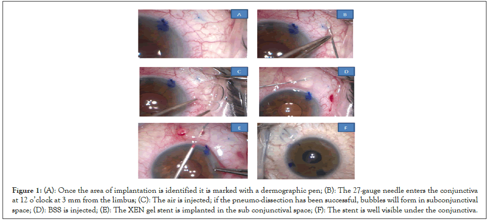 implantation