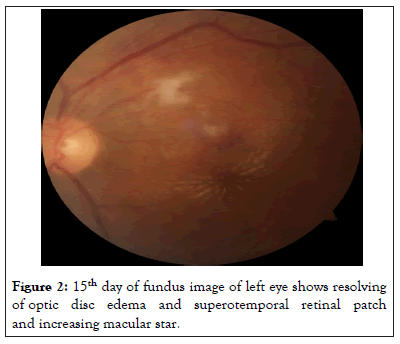 macular