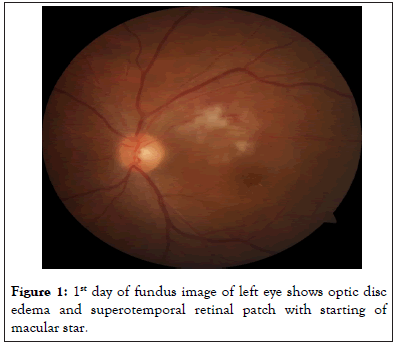 retinal