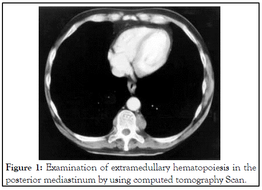 extramedullary