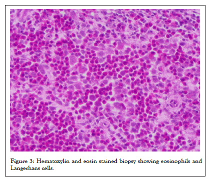 biopsy