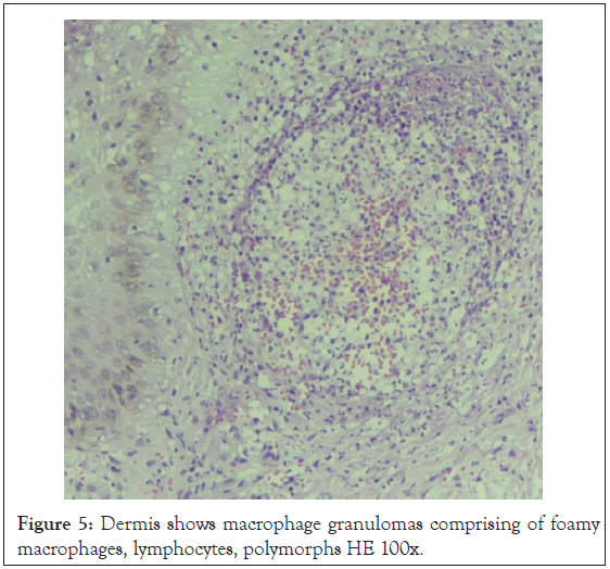 granulomas