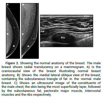 Can Ultrasound Detect Gynecomastia