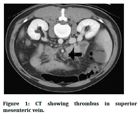 Research-Dental-thrombus