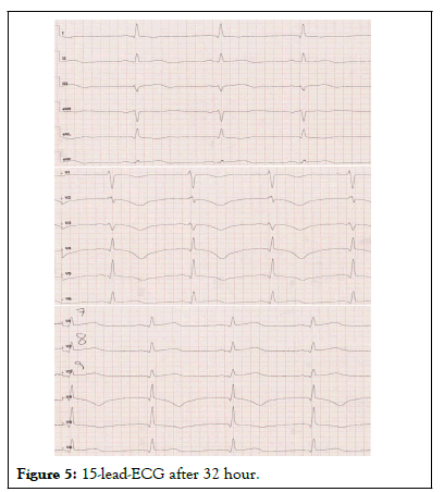 ECG