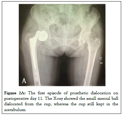 prosthetic