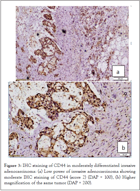 cancer-science-research-adenocarcinoma