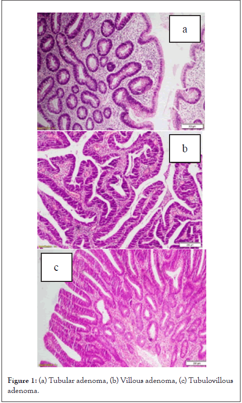 cancer-science-research-adenoma