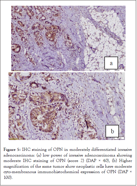 cancer-science-research-invasive