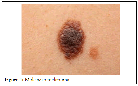 melanoma