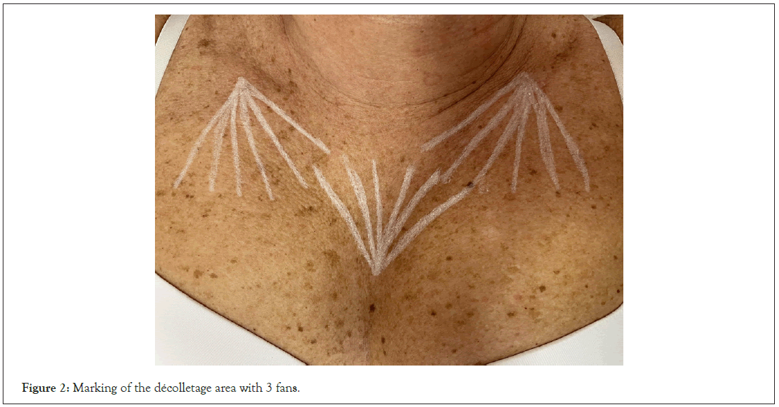 MP - ADD Decolletage - The Cosmetic Clinic