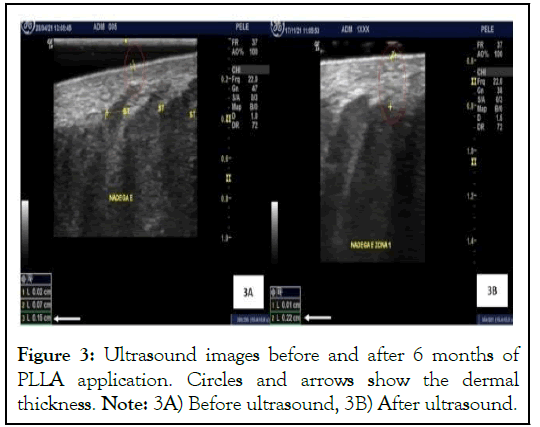 Ultrasound