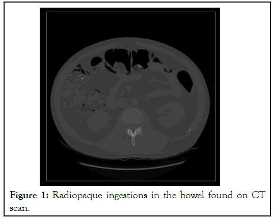 Radiopaque