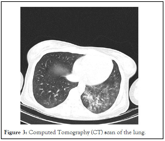 Tomography