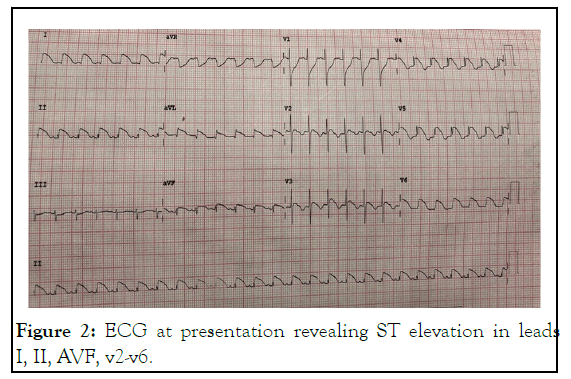 egm-ECG