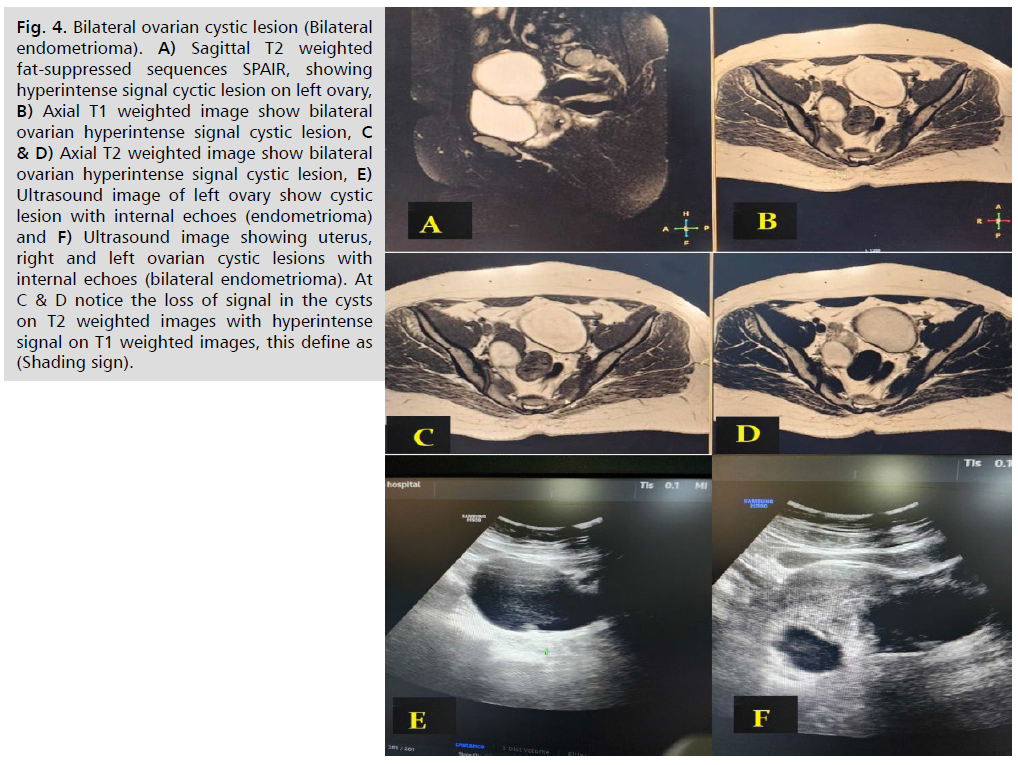 ginekologia-endometrioma